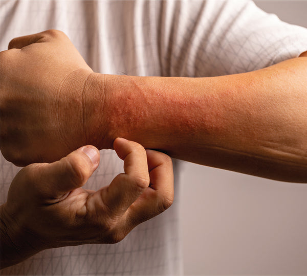 Man scratching eczema on forearm