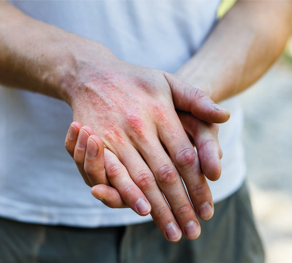 Man with eczema rash on hands