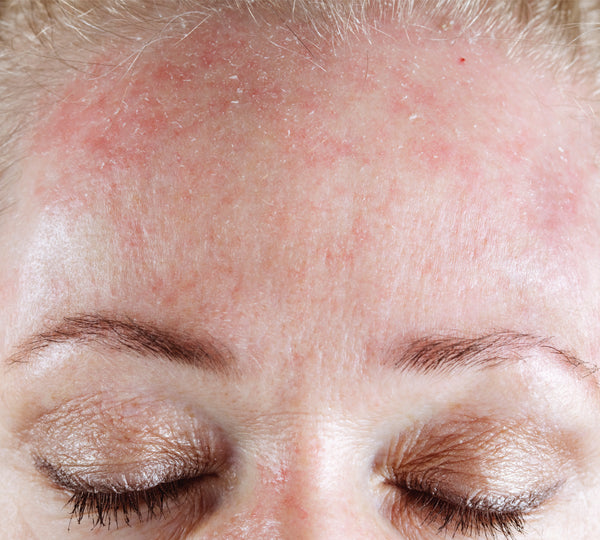 Dry skin on forehead 
