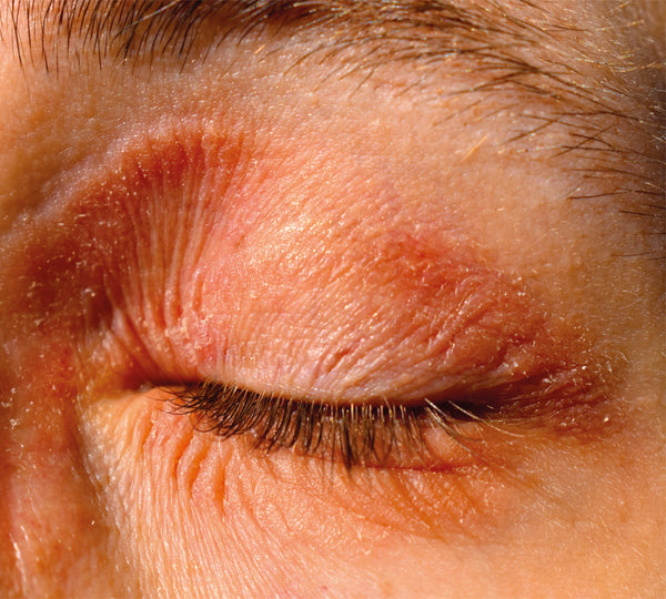 eczema around eyes
