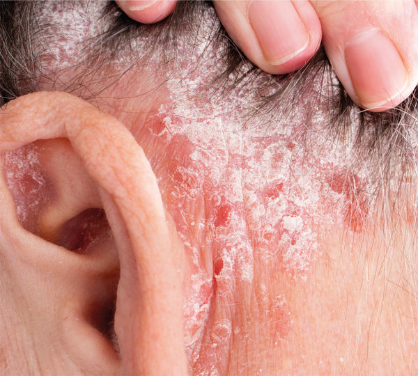 Eczema behind ears 