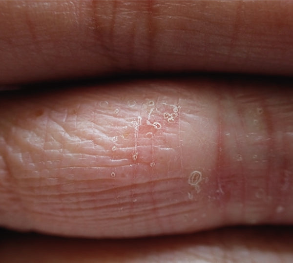 Close up of eczema on fingers
