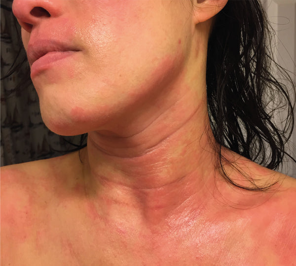 Woman with eczema flare up on face, neck and chest