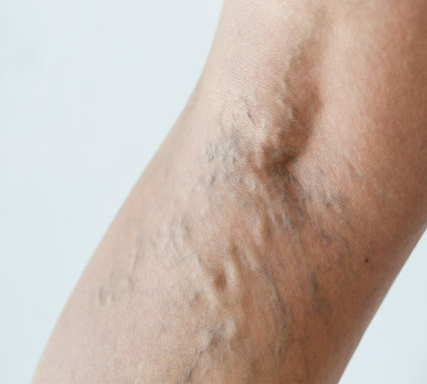 Varicose eczema on back of leg