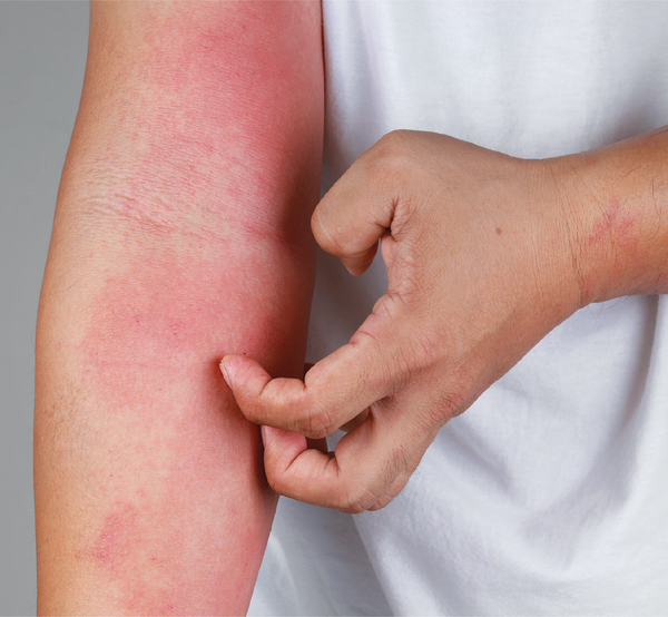 Man scratching atopic dermatitis on arm
