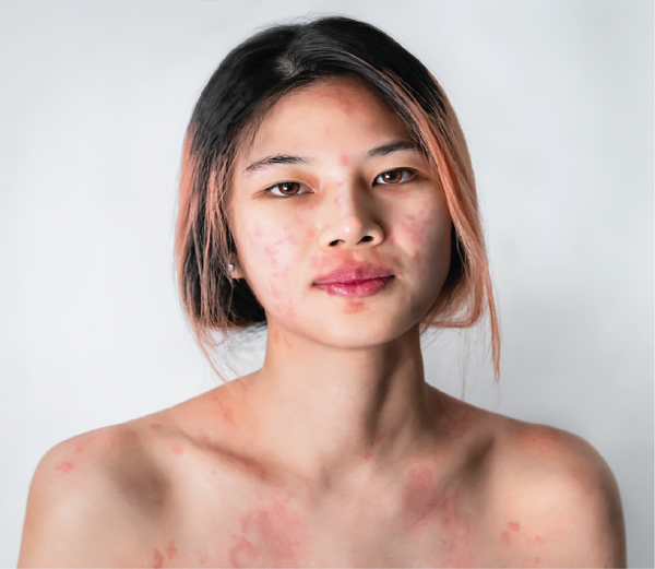 Woman with eczema flare up on face