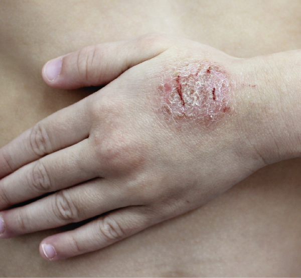 Discoid eczema on hand