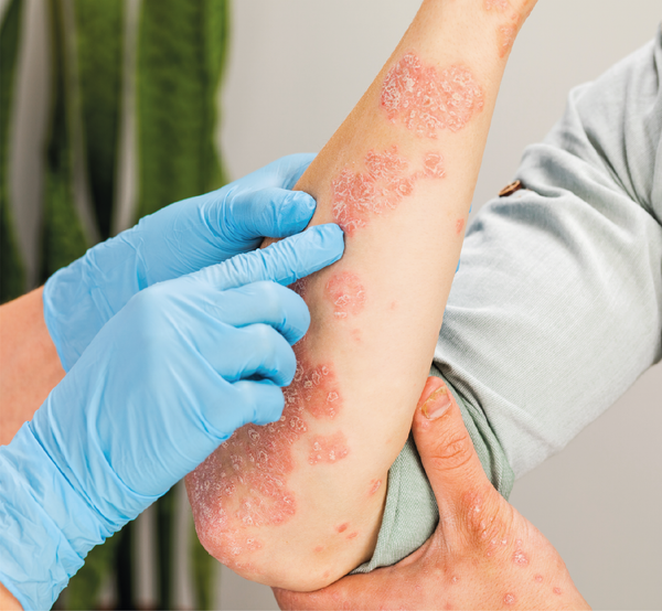 Eczema rash on arms