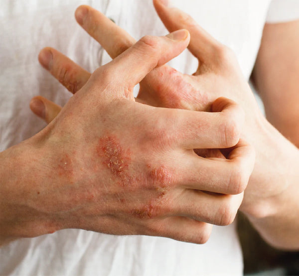 Man scratching eczema on hands