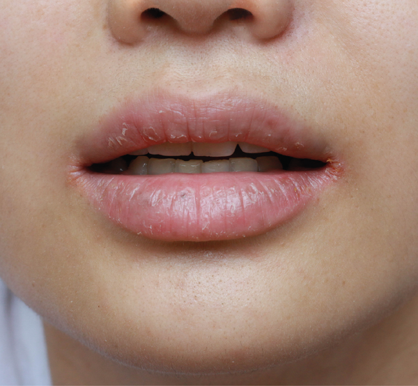 Eczema on the lips