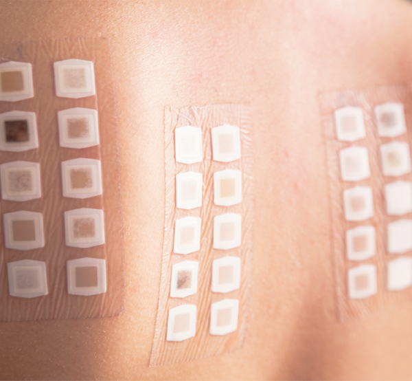 Patch test for allergies on back