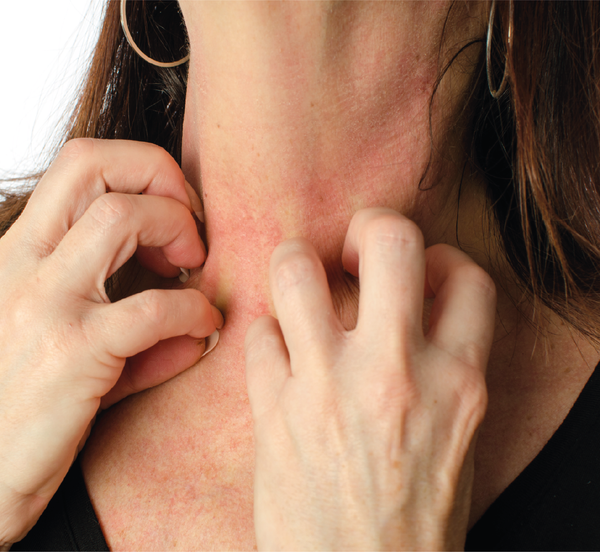 Woman scratching eczema on neck