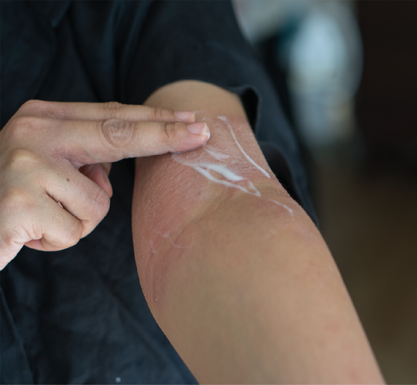 Man applying cream to eczema on arm