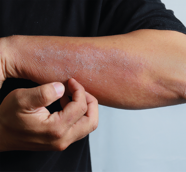 Man scratching eczema on forearm